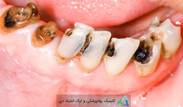 تأثیر مصرف شیشه بر دندان