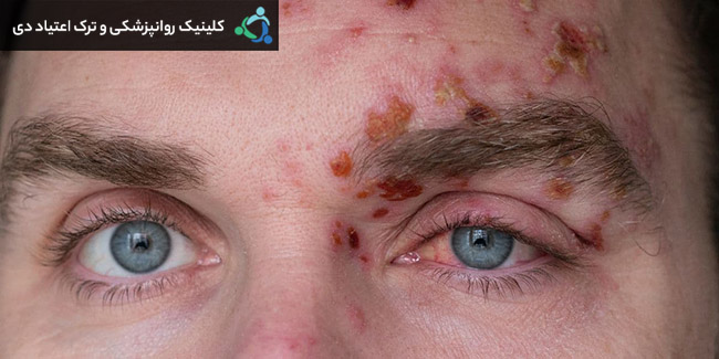 عوارض مواد محرک