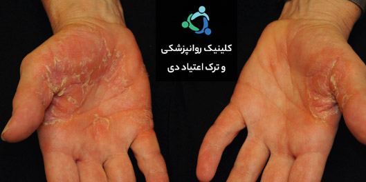 عوارض آمفتامین