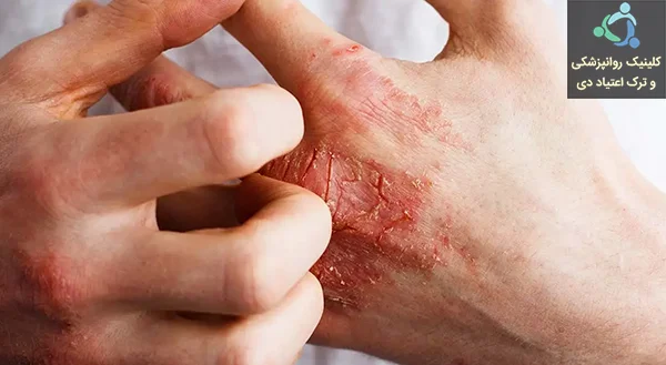 عوارض مخدر کروکودیل