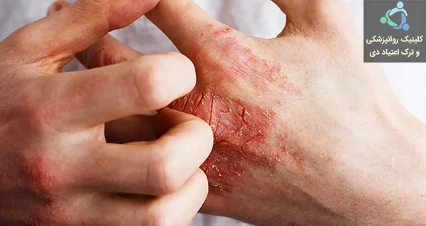 عوارض ماده مخدر کروکودیل