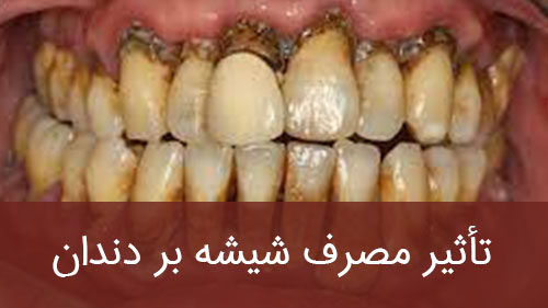 تأثیر مصرف شیشه بر دندان